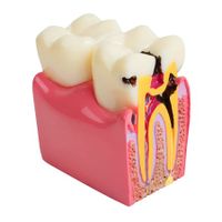 Dental Teeth Model Dental Caries Tooth Model Patient Education Teeth Model 6 Times Caries